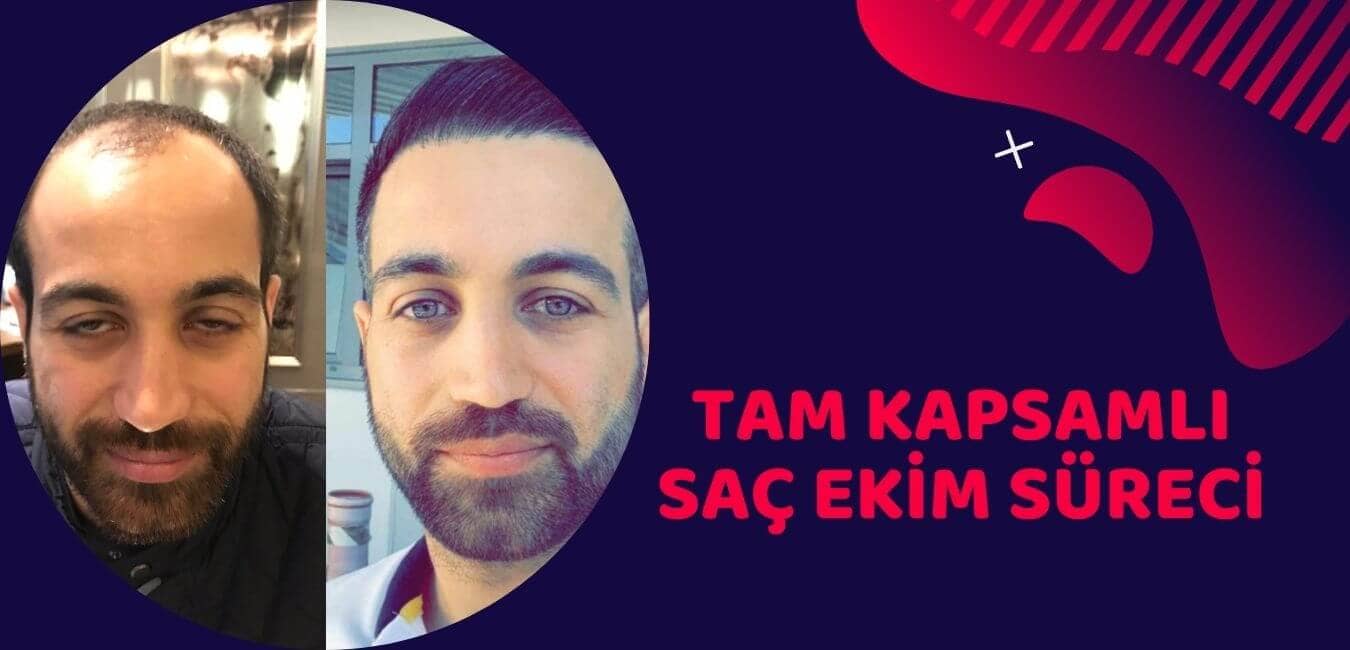 saç ekiminin tam kapsamlı süreci