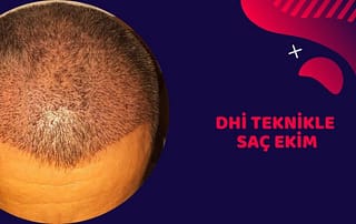 dhi teknikle saç ekim