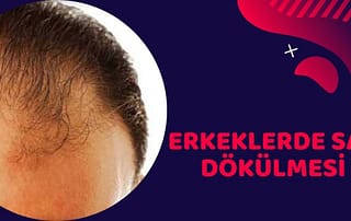 saç dökülmesi