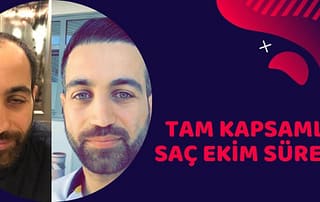 saç ekiminin tam kapsamlı süreci